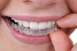 tratamiento-ortodoncia-estetica-meddicus