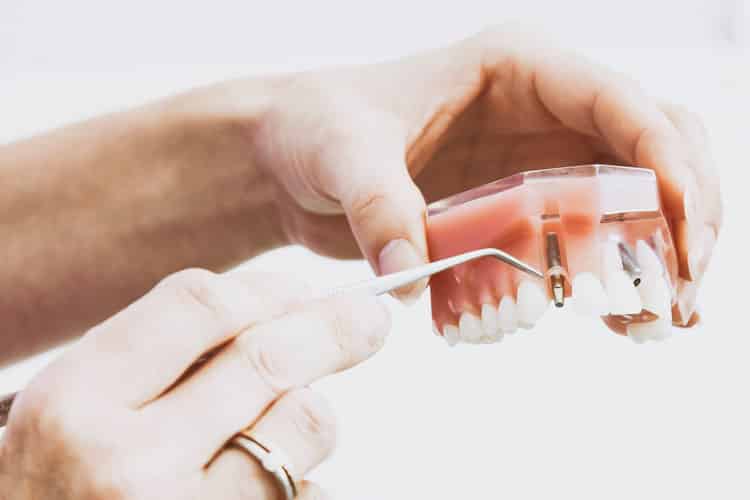 implante-dental-meddicus-toledo