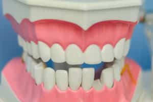 implantes-dentales-meddicus-toledo