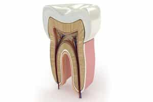 tratamiento-endodoncia-dental-meddicus