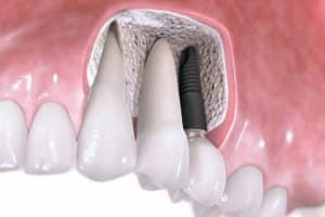 tratamiento-protesis-e-implantes-dentales-meddicus